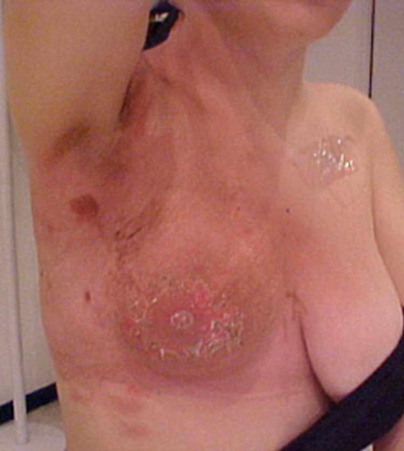 Breast Cancer and Dermatitis Herpetiformis - treato.com