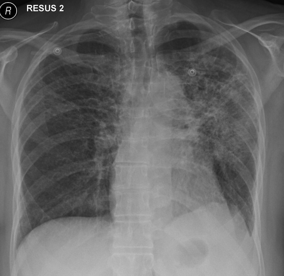 Pemetrexed-Induced Interstitial Pneumonitis: A Case Study and ...